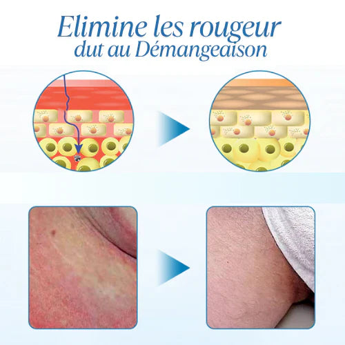 CREME ANTI DEMANGEAISON : APAISEZ, TRAITEZ ET PROTEGEZ - RESULTAT IMMEDIAT